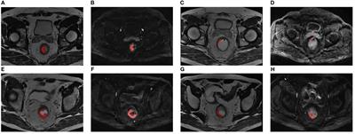 A multiple-time-scale comparative study for the added value of magnetic resonance imaging-based radiomics in predicting pathological complete response after neoadjuvant chemoradiotherapy in locally advanced rectal cancer